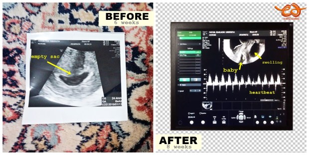 empty sac ultrasound